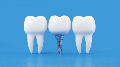 Dental İmplantlar: Eksik Dişler İçin Kalıcı Çözüm