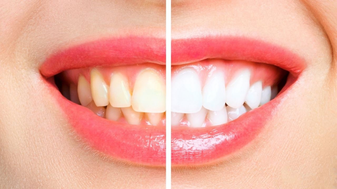  Diş Beyazlatma nedir? 